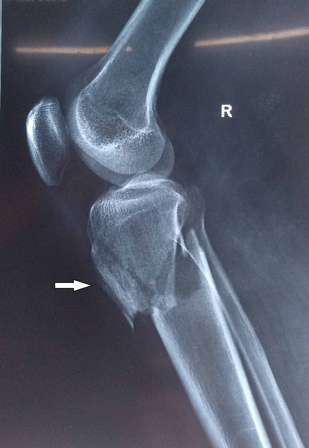 tibial plateau fracture swelling