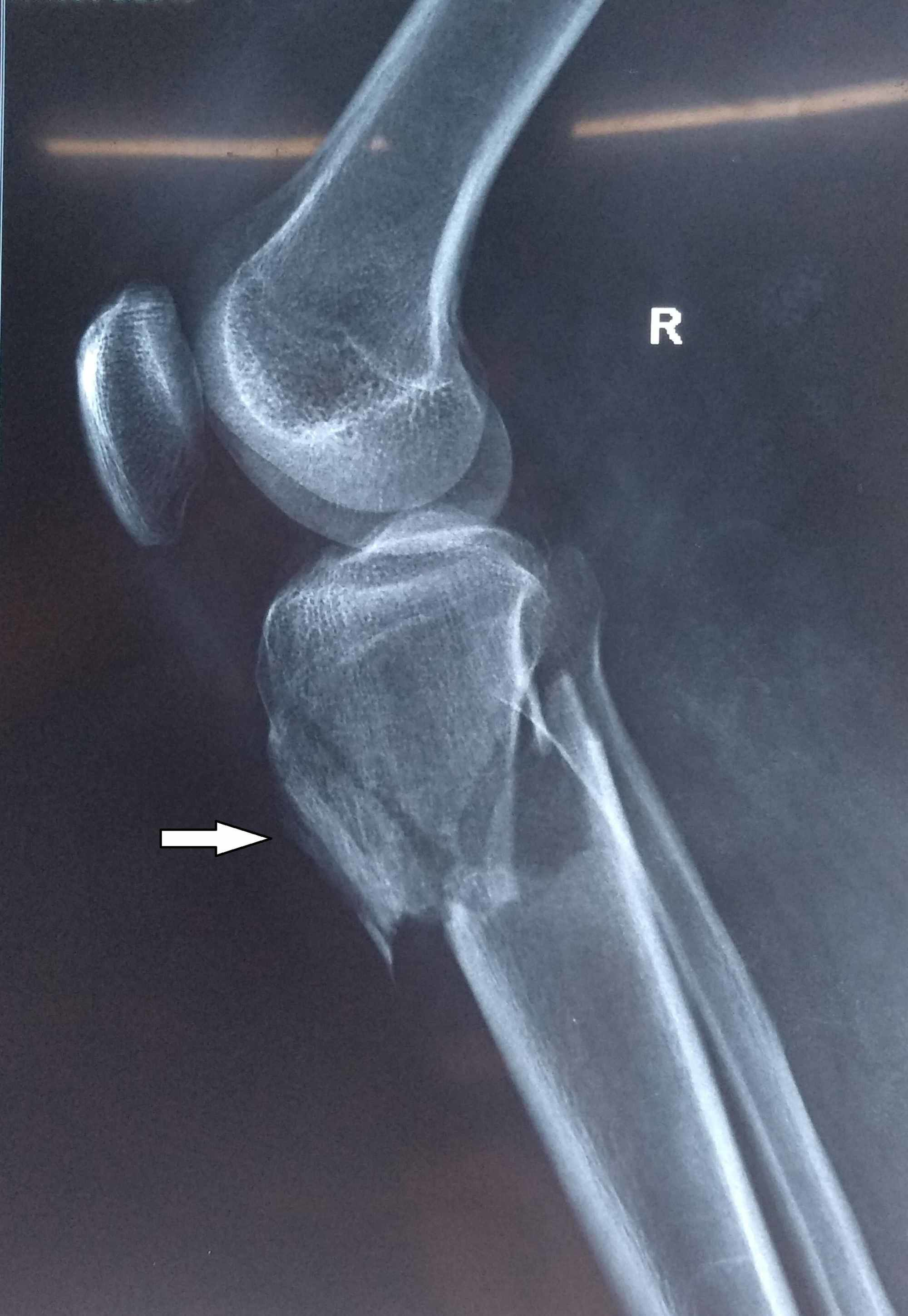 occult tibial plateau fracture