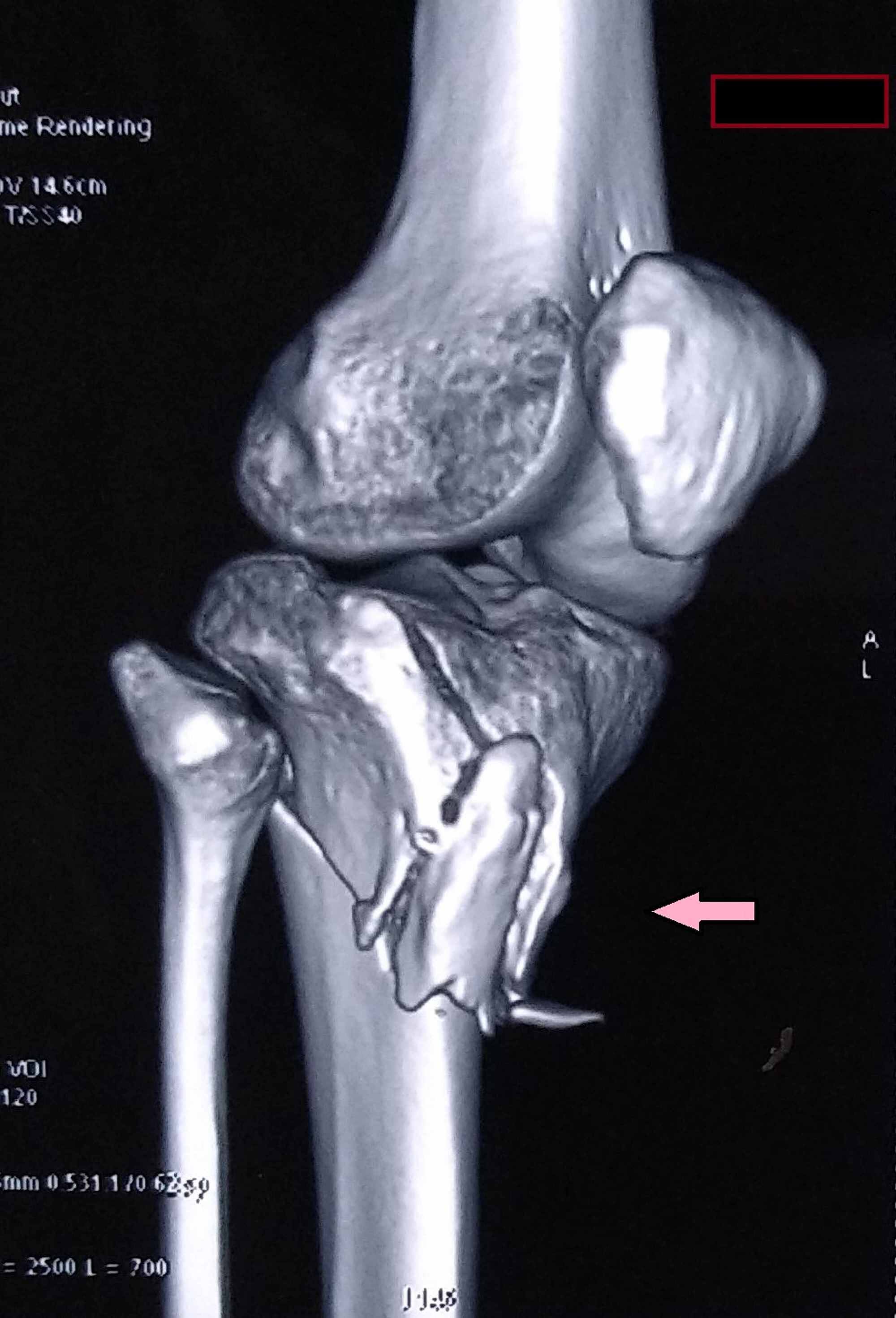 tibia fracture