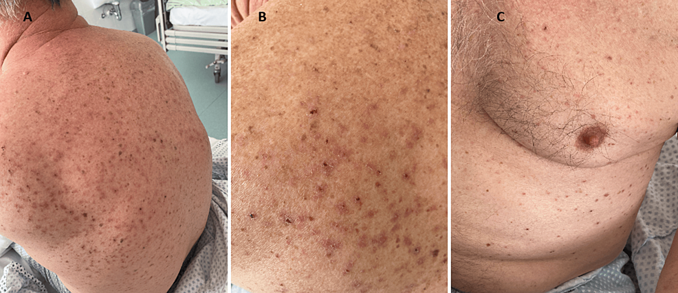 Cureus | A Grover-Like Skin Rash: A Potential Indicator of Underlying  Severe Acute Respiratory Syndrome Coronavirus 2 (SARS-CoV-2) Infection |  Article