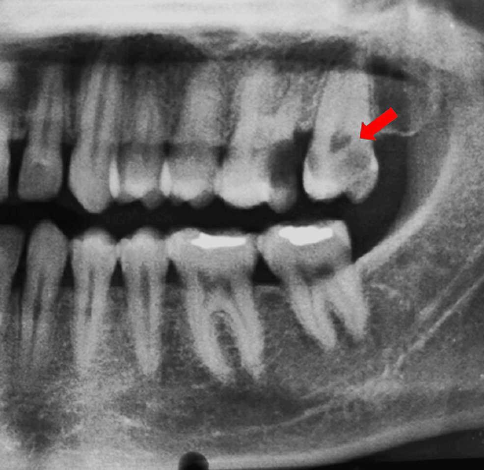 Uncovering the Enigma of the C-shaped Root Canal Morphology