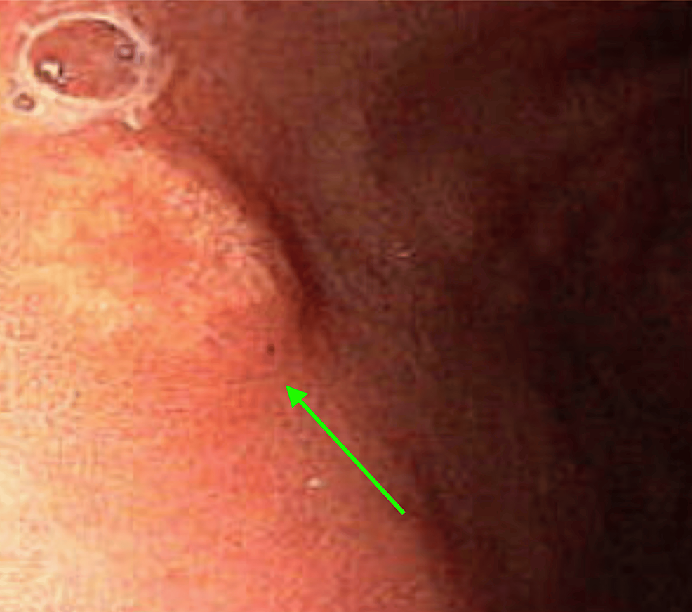 Photos show yellow 'cholesterol nodules' on man's palms. Here's what he ate  that caused it | Snopes.com, image size:986x871