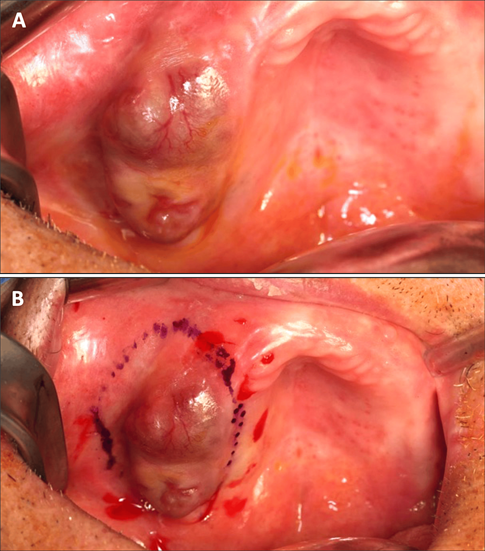 Clinical-situation-(A)-The-nodular-lesion-could-be-observed-on-the-ridge-(B)-Delimitation-of-surgical-margins.