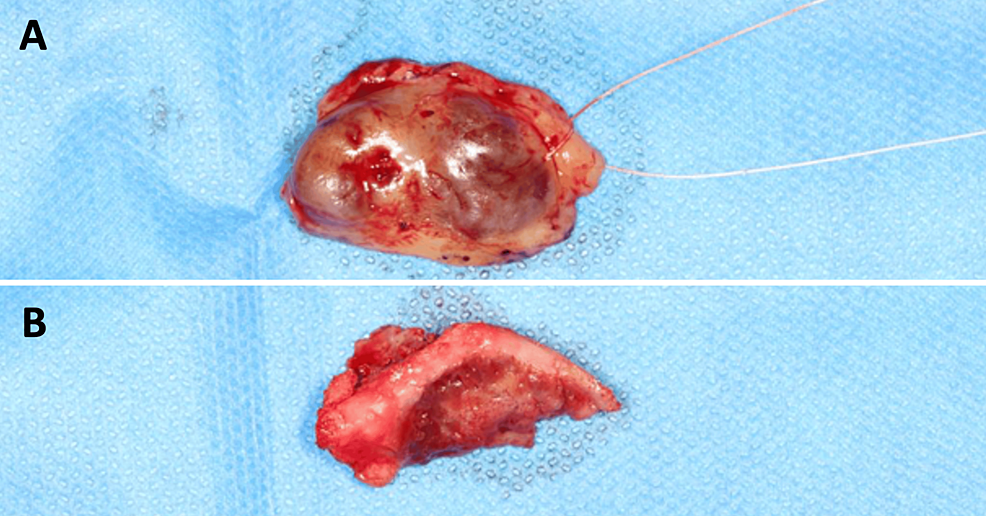 Surgical-pieces-for-(A)-mucosal-excision-and-(B)-bone-resection.