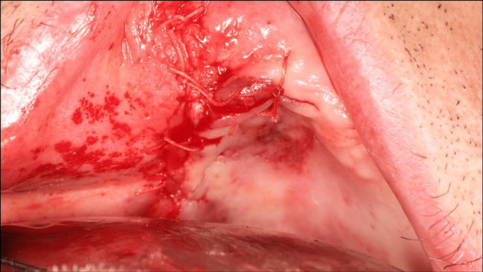 Primary-wound-closure-of-surgical-site.