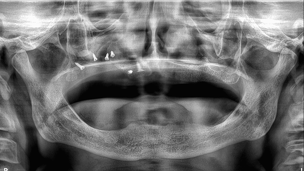 Immediate-post-operative-panoramic-X-ray.