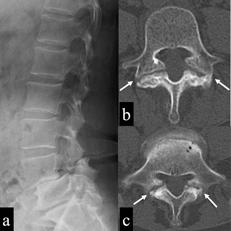 Combined Transforaminal Lumbar Interbody Fusion And Smiley Face Rod ...