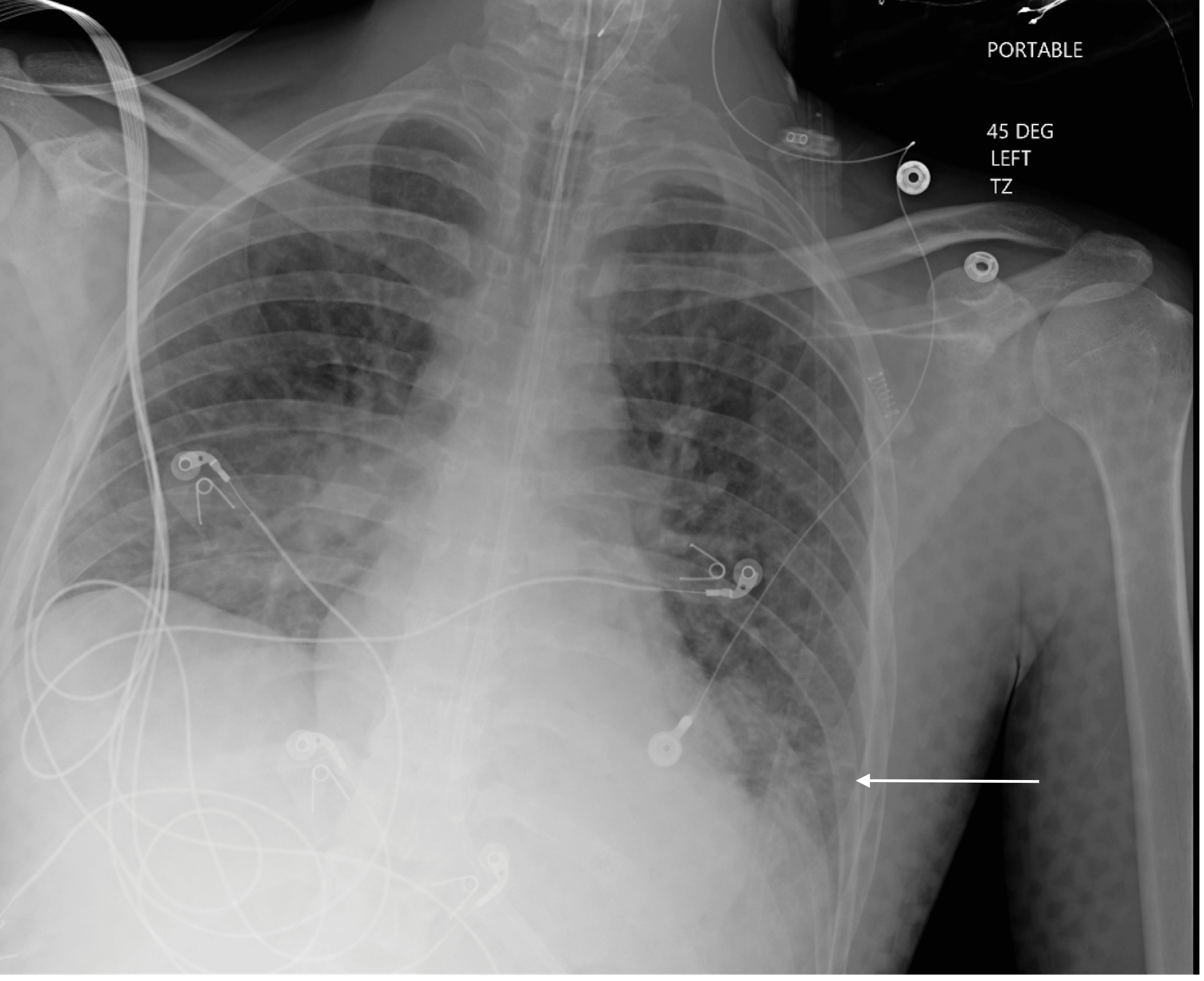 Lance Adams Syndrome in the Setting of COVID-19 Pneumonia | Cureus