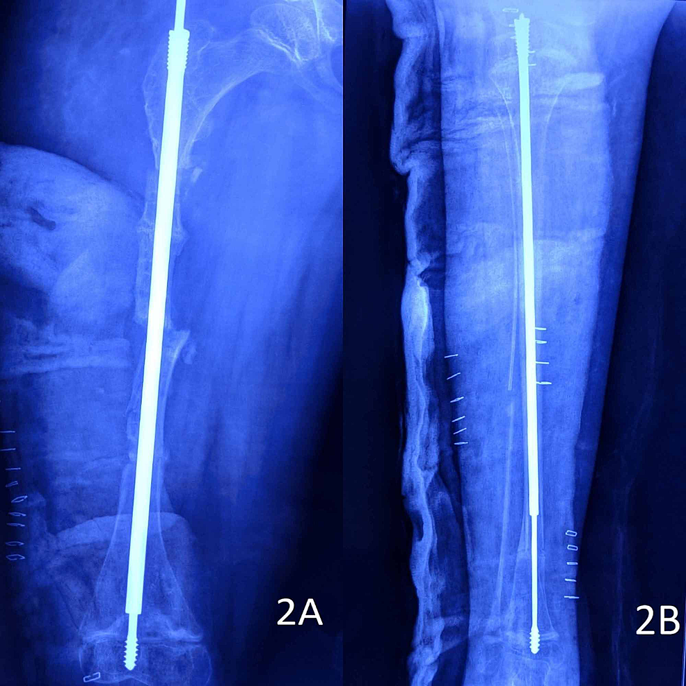 Immediate-postoperative-radiographs-of-the-patient