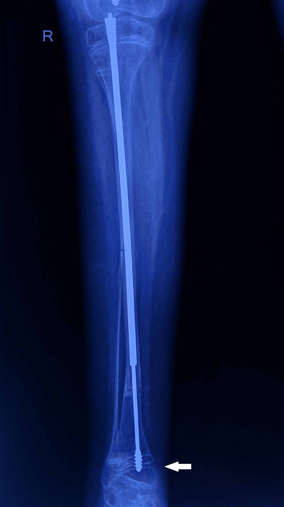 Follow-up-radiograph-of-the-right-tibia