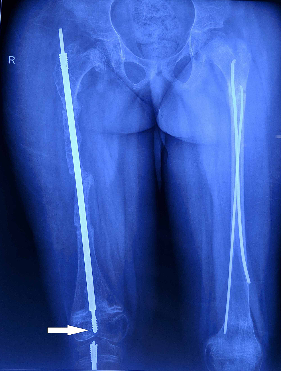 Follow-up-radiograph-of-the-right-femur