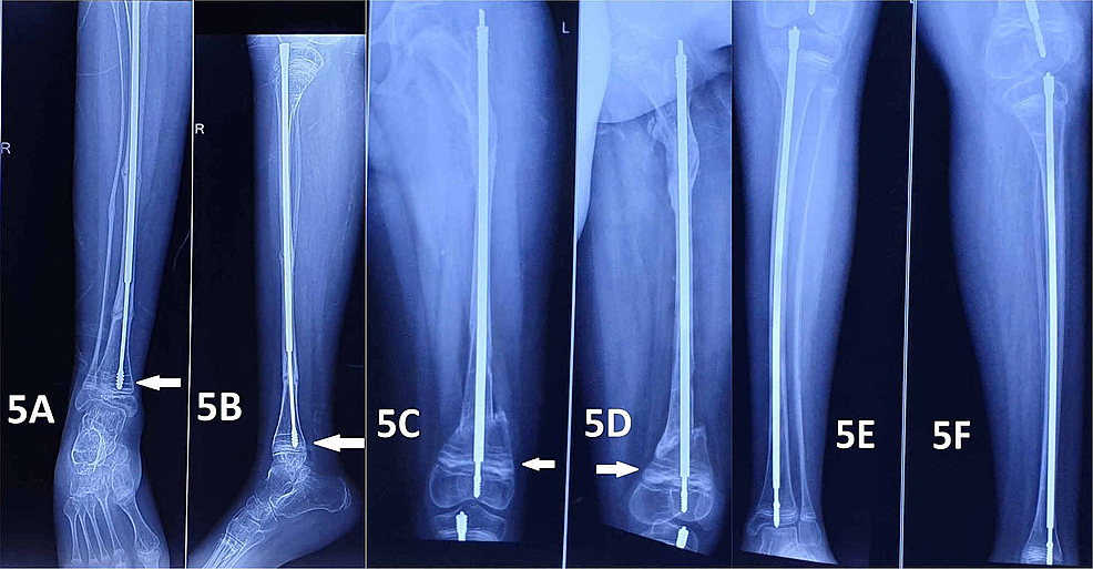 Radiographs-obtained-during-the-follow-up-visit-six-months-after-the-second-surgery