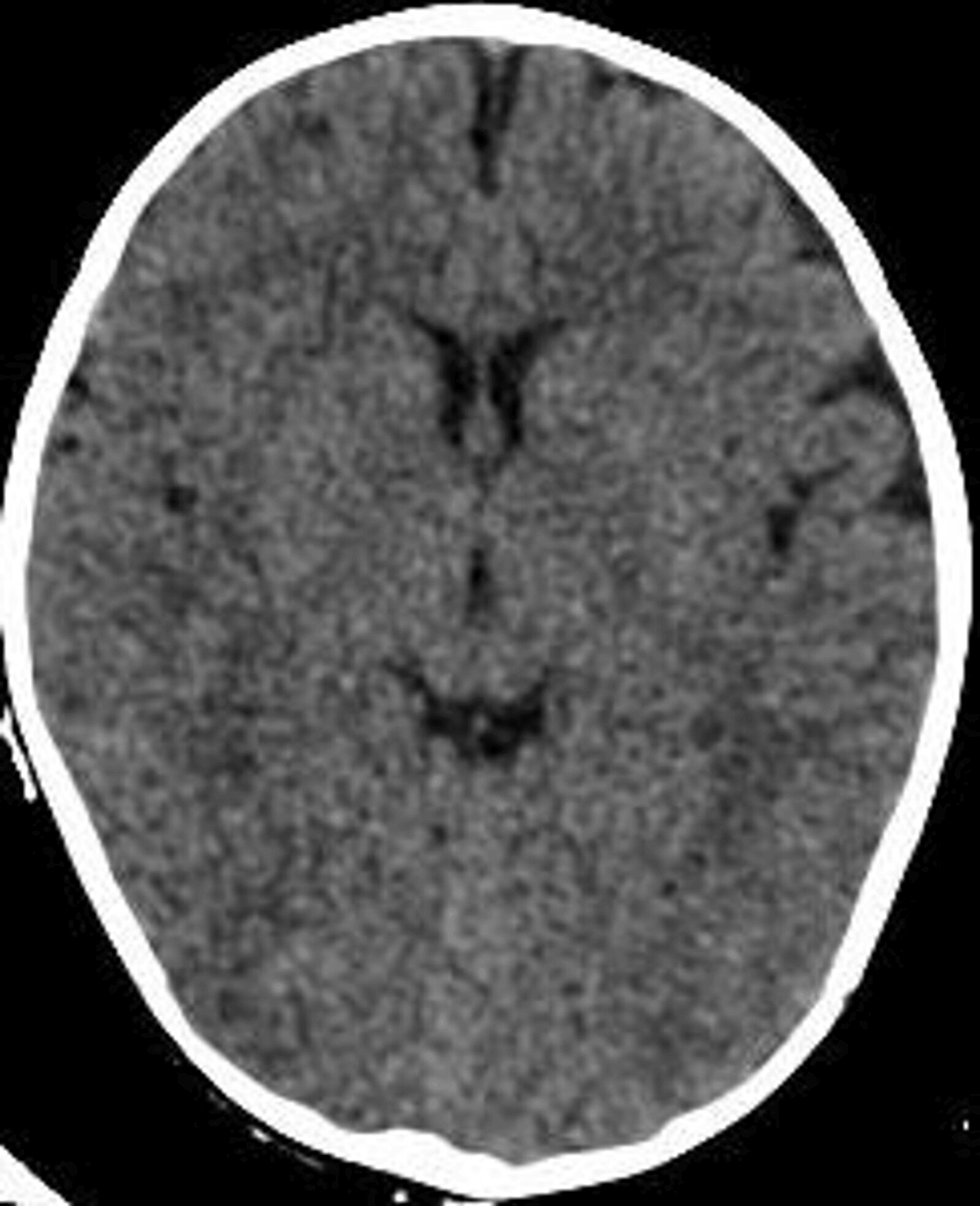 Infantile Status Epilepticus A Case of Excessive Water Intake in a