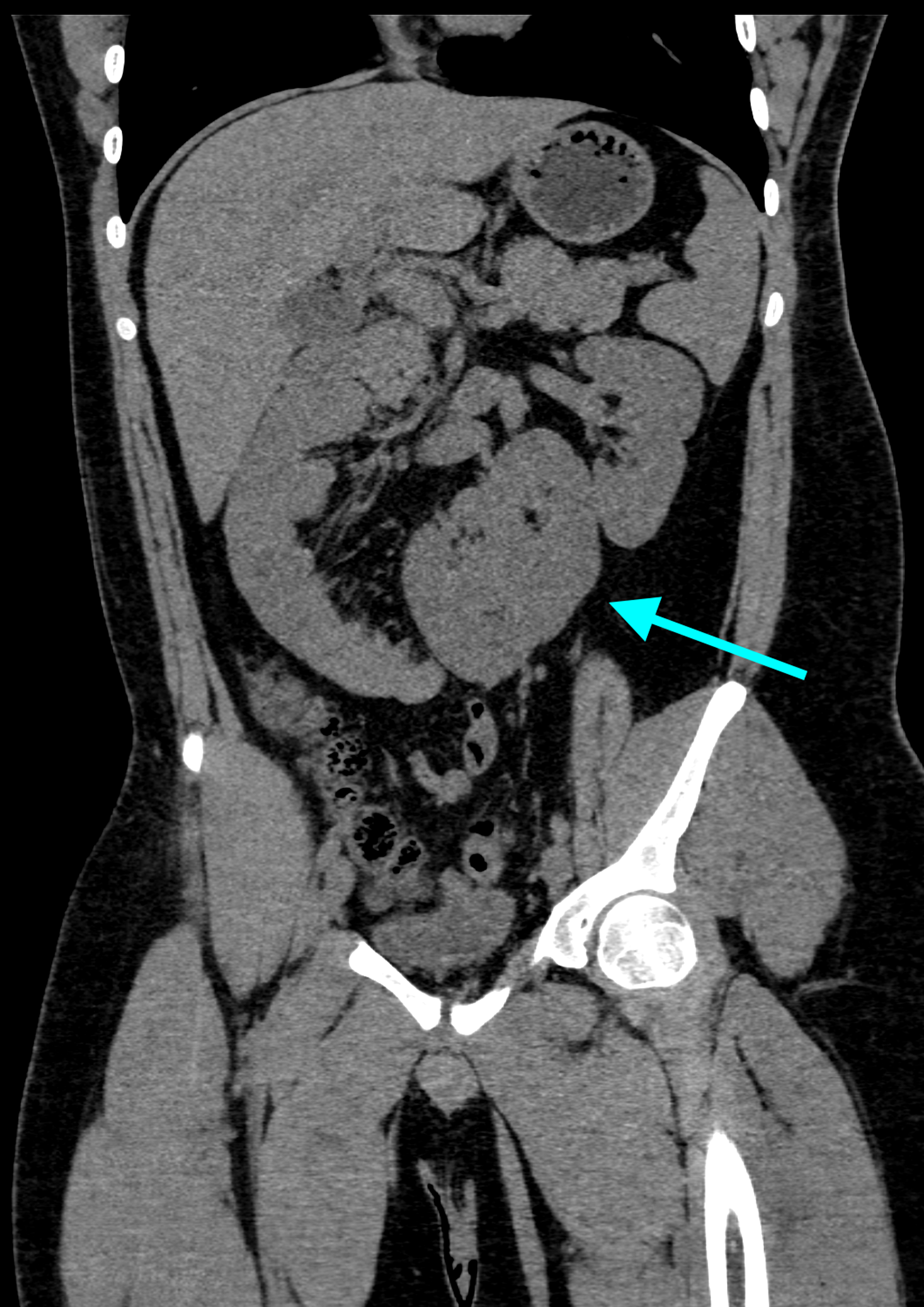 Cureus Crossed Renal Ectopia with a Fused Supernumerary Kidney