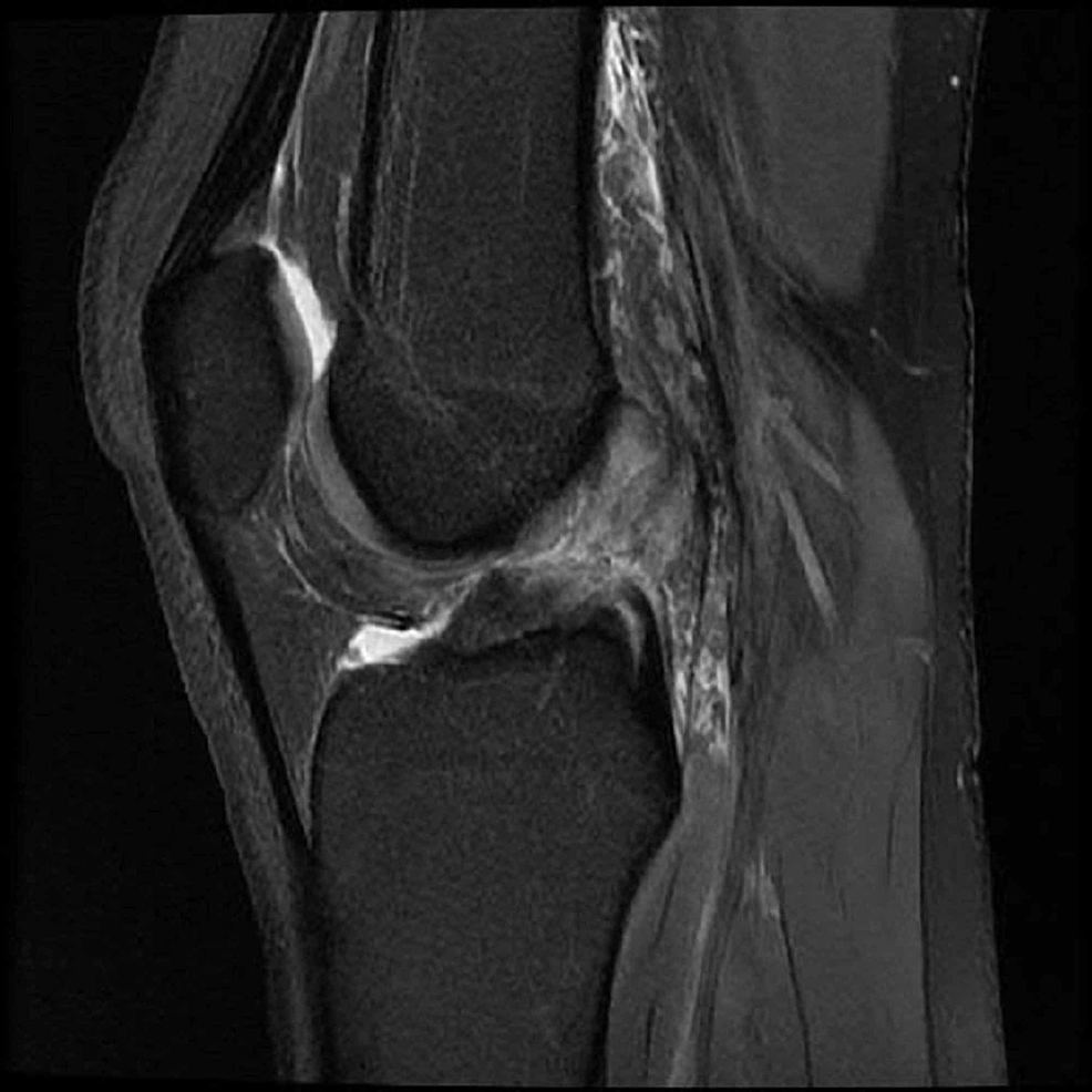 Cureus | Seeing Double: A Case of ACL Tears in Monozygotic Twin Female ...