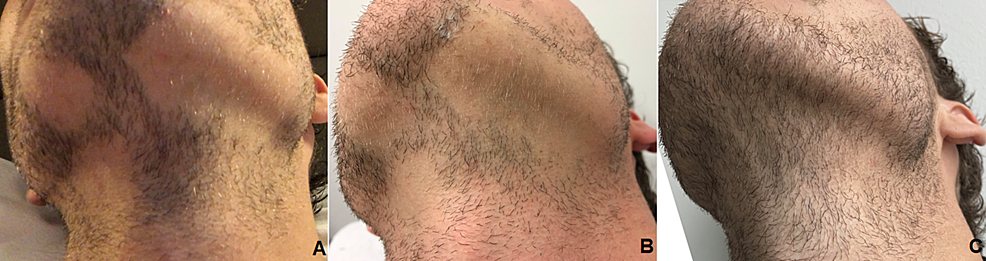 Bald spots and patchy beards Alopecia explained  GQ India