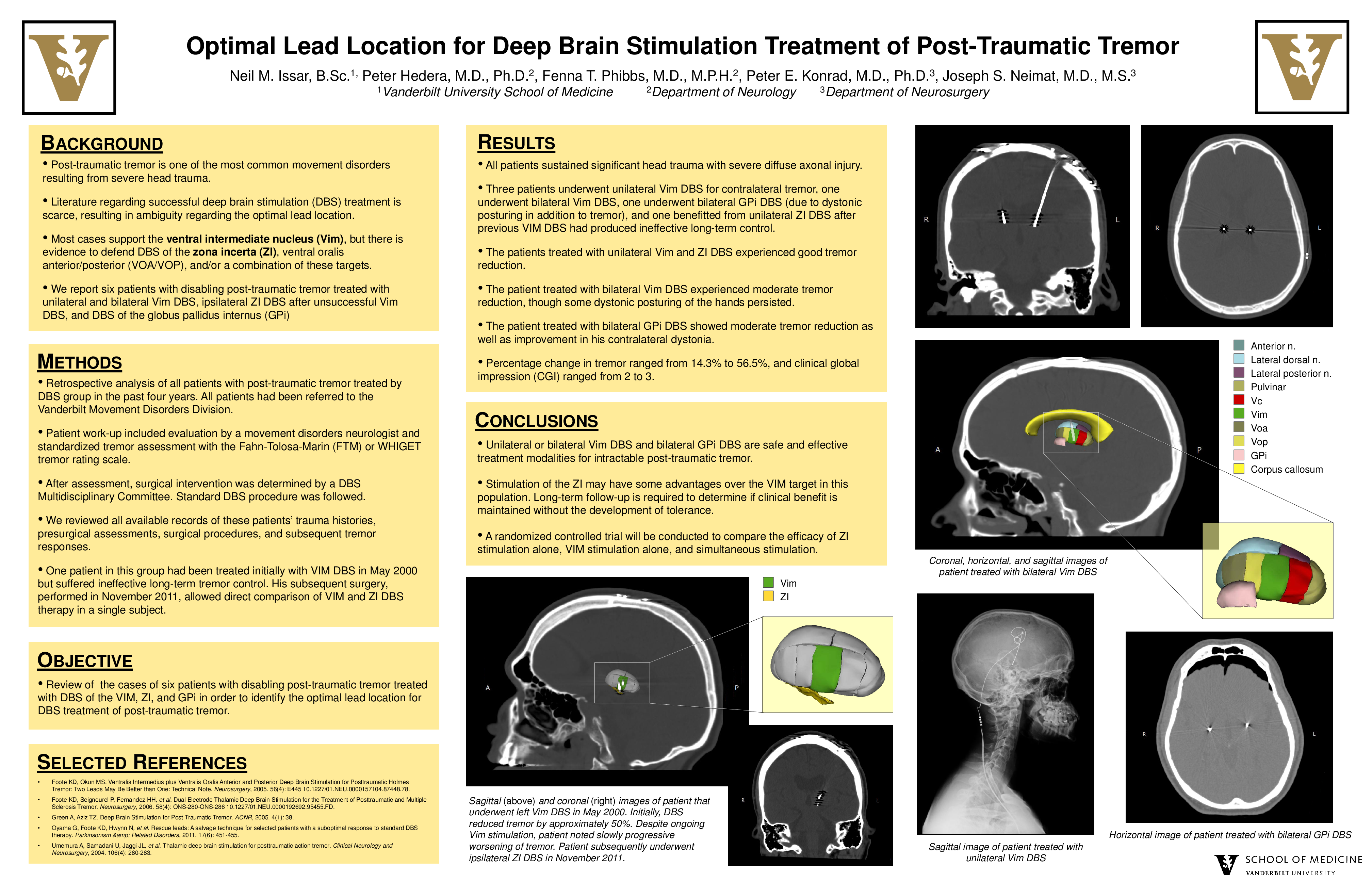 Cureus | Optimal Lead Location for Deep Brain Stimulation ...