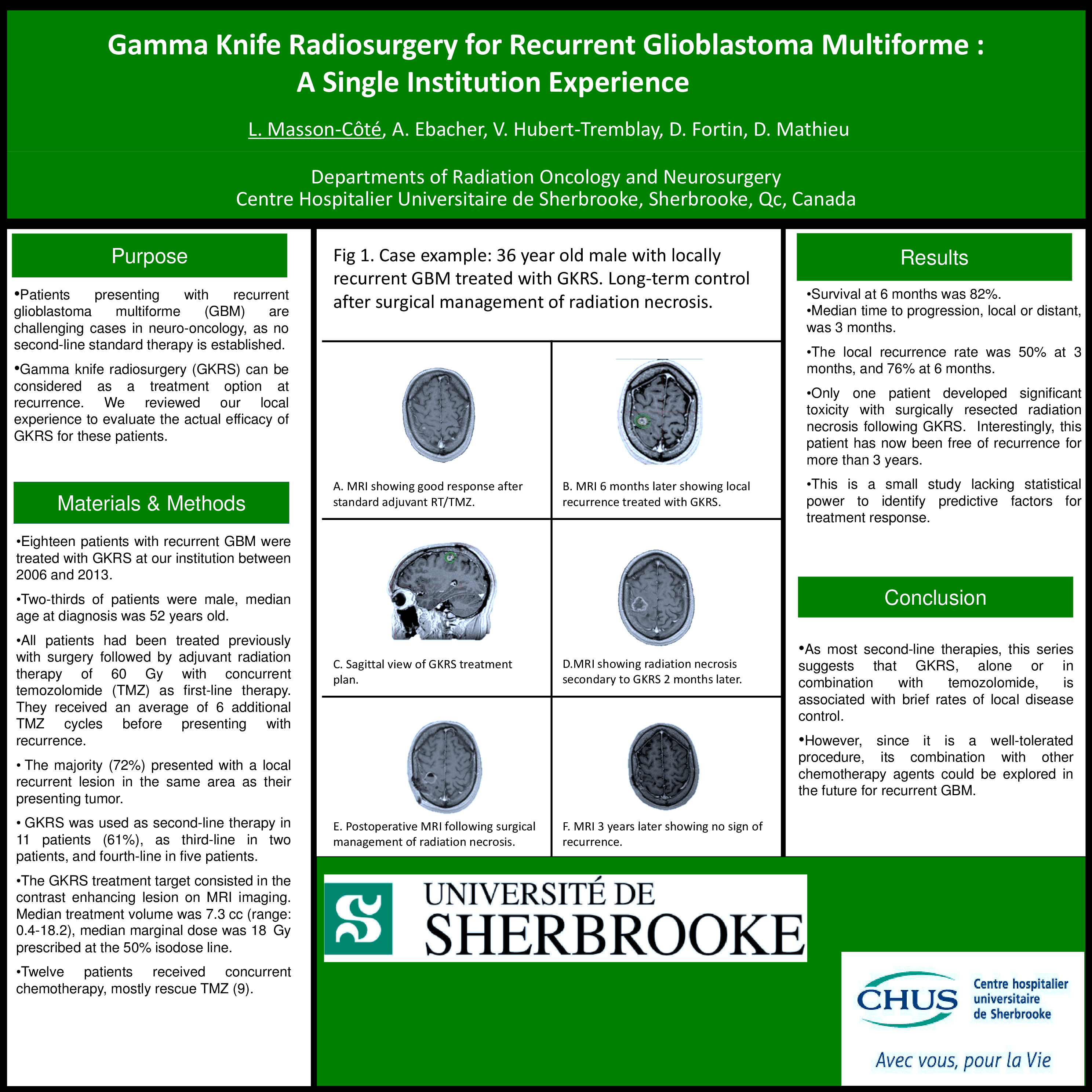Cureus Gamma Knife Radiosurgery for Recurrent Glioblastoma Multiforme