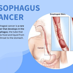 Esophagus  Cancer (Slukdermkanker) Jr.